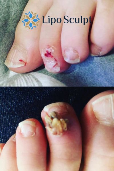 Wart removal customer results from Lipo Sculpt Chigwell