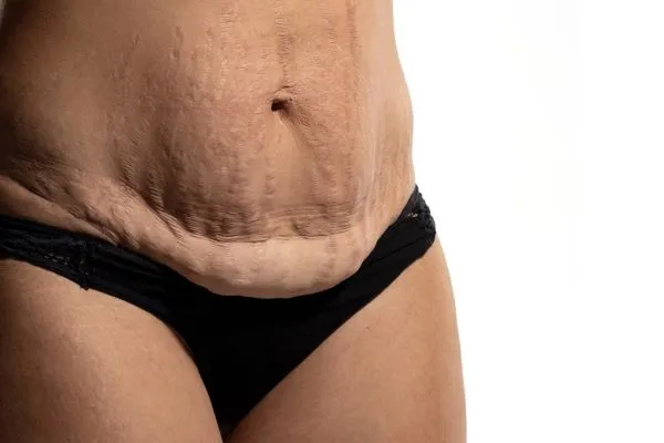 Lost the Weight but Not the Loose Skin? 1 image of womans stomach after weight loss showing loose skin Chigwell